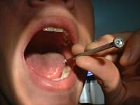 Emergency tooth repairs